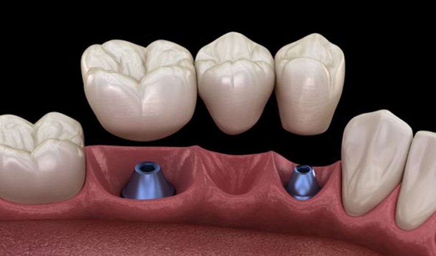 Top Dental Crown Maintenance Tips