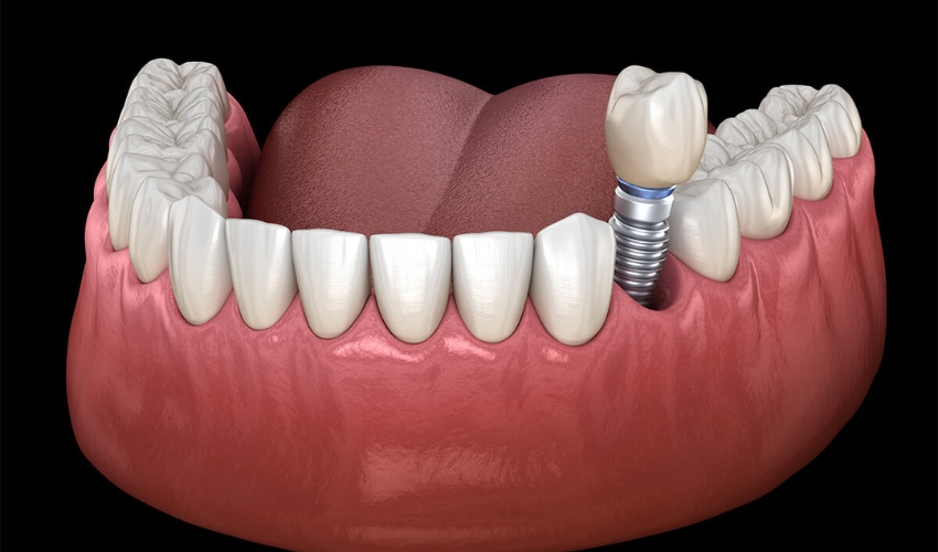 The Healing Process After Getting Dental Implants A Step-By-Step Overview