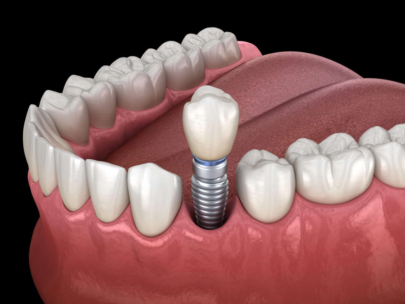 Prevent an Infection After Getting Dental Implants