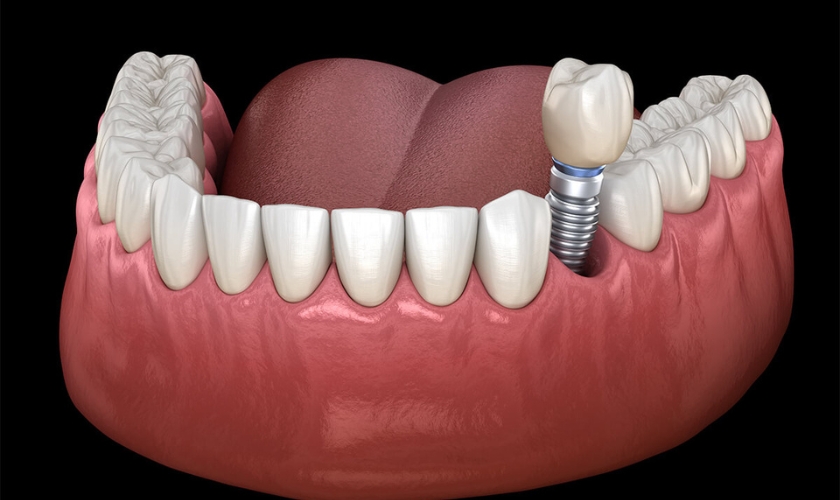 Benefits And Importance of Dental Implants