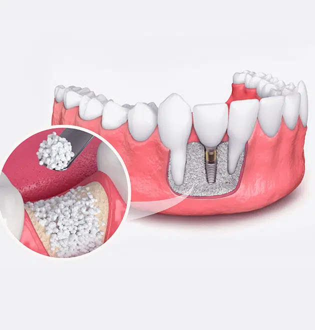 Bone Graft for Dental Implants