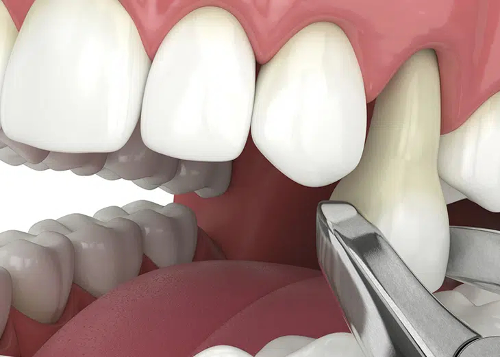 Dental extraction of upper tooth using professional dental tool