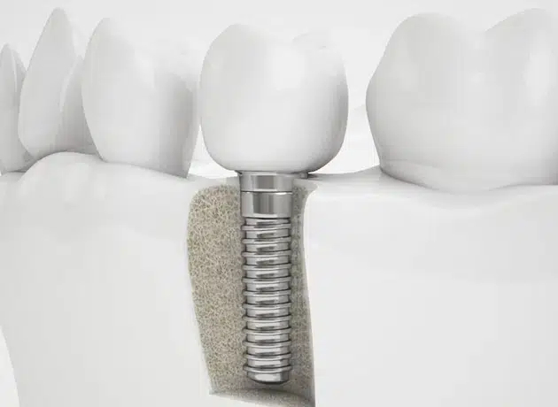 Dental Implants in Cary NC