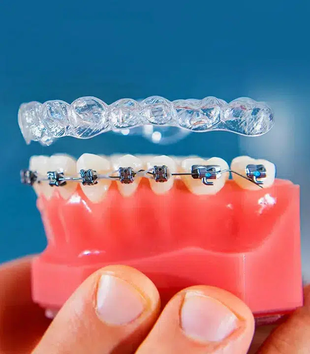 Invisalign and Braces