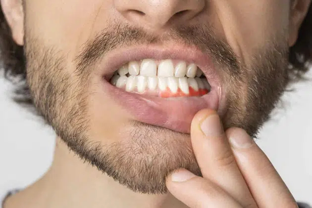A man in Cary, NC experiencing gum recession on his lower teeth
