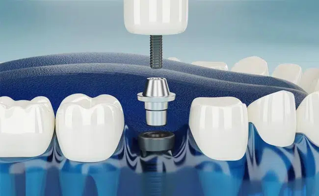 Single Tooth Implants in Cary NC