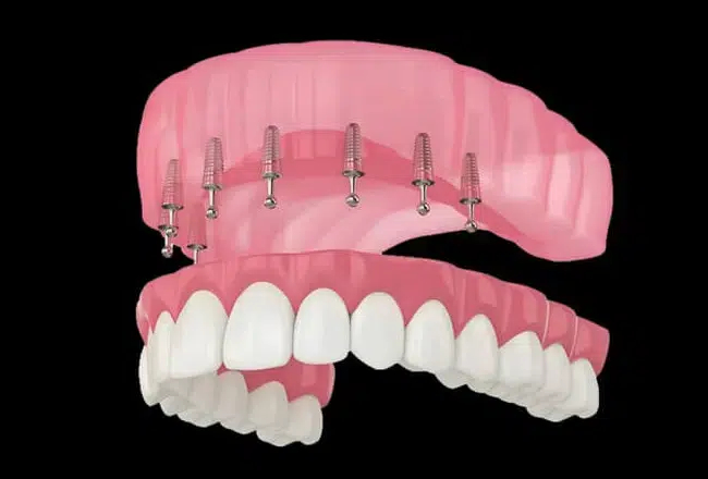 Snap-In Implant Dentures in Cary NC