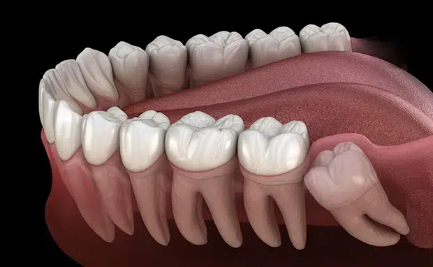 Wisdom teeth extraction in Cary NC