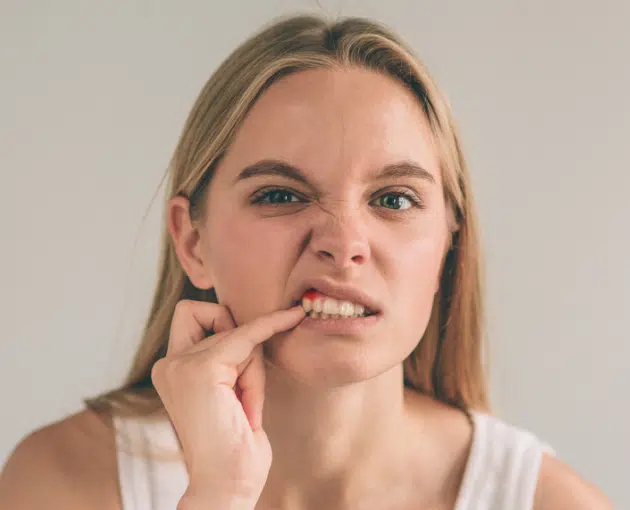 A woman in Cary NC showing symptoms of gum inflammation and bleeding