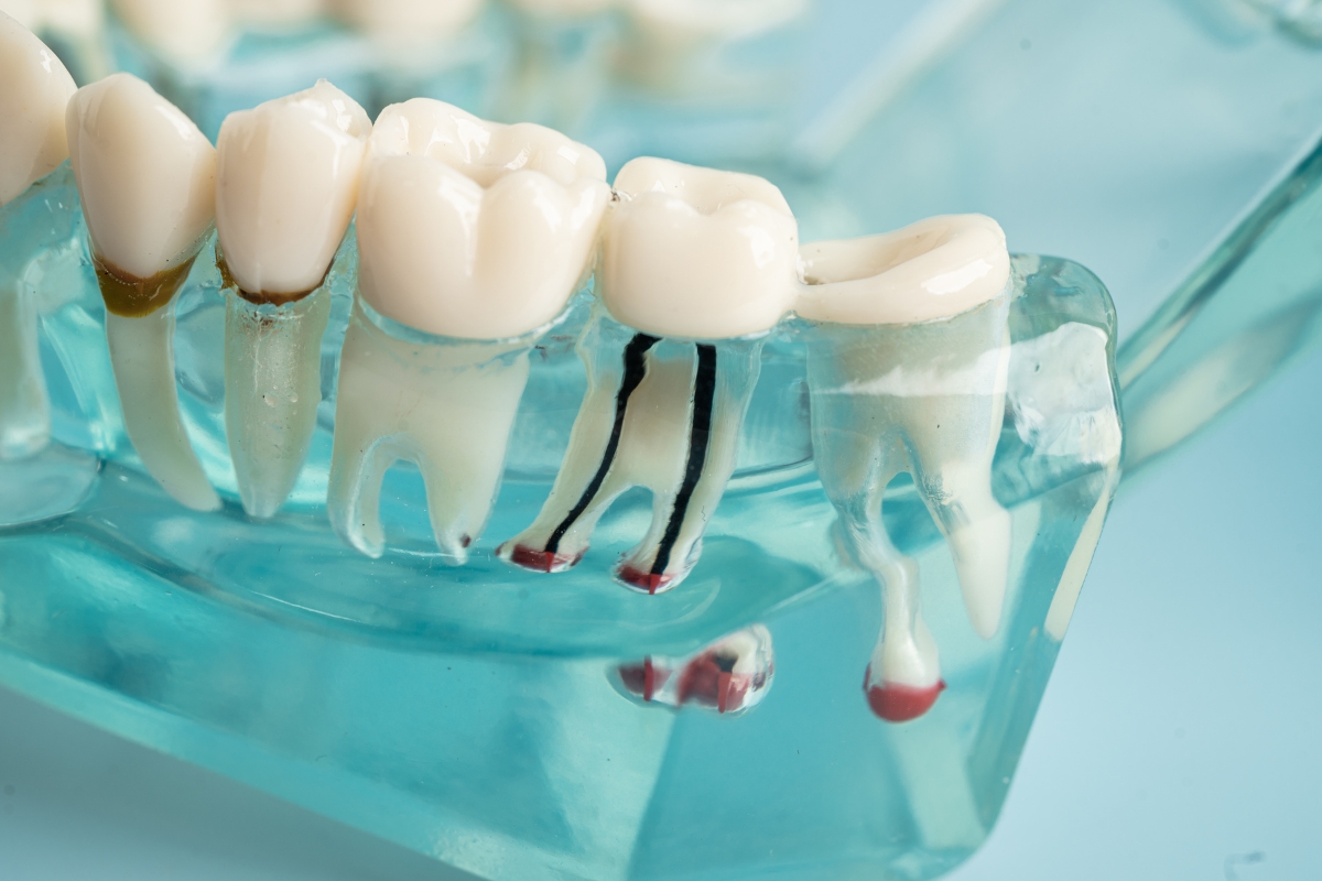 Gentle-Root-Canal-Care-in-Cary