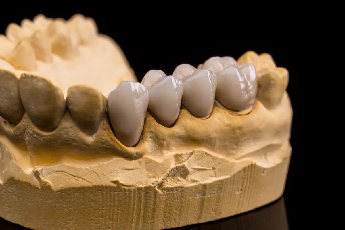Your-First-Time-Guide-to-Dental-Crowns-in-Apex-NC
