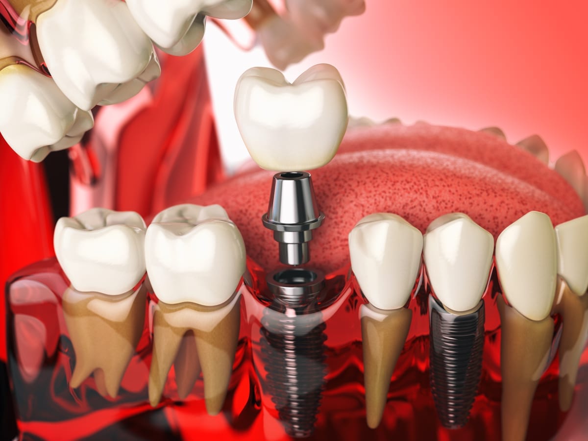 Dental Implants in Cary