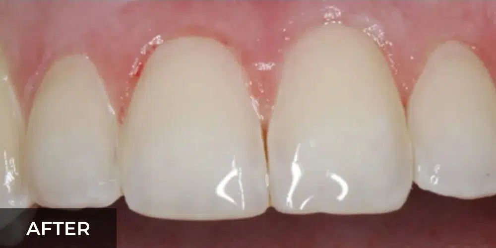 chipped front teeth after