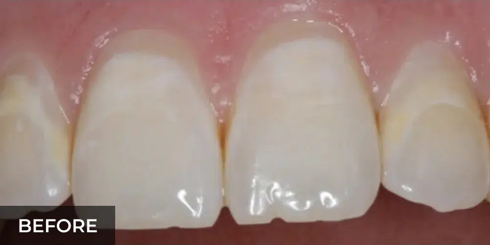 chipped front teeth before