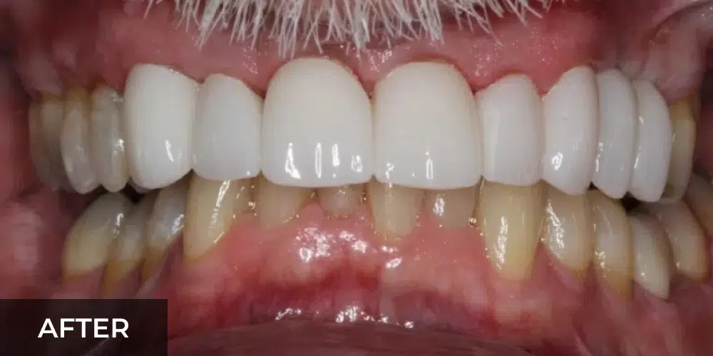 cosmetic dental veneers after
