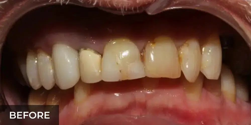 Before cosmetic dental veneers showing discolored and misaligned upper teeth.