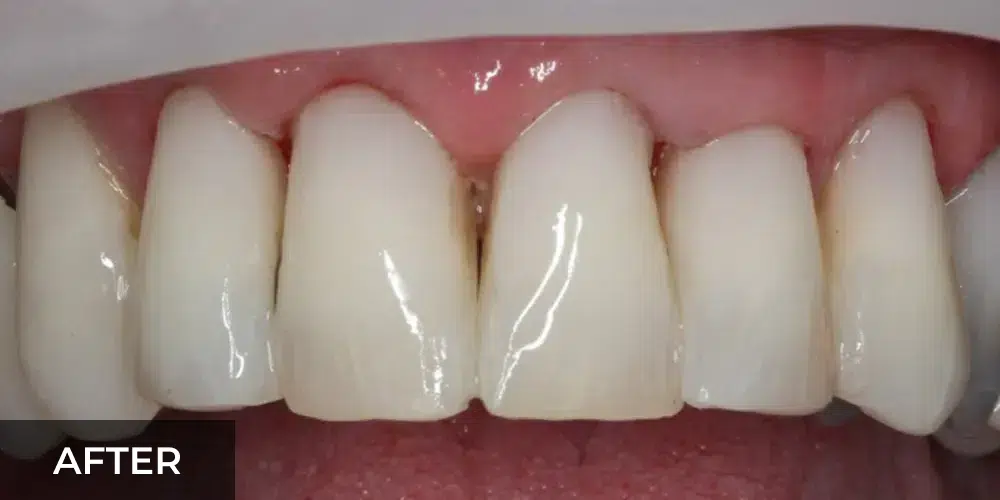 cosmetic smile makeover after