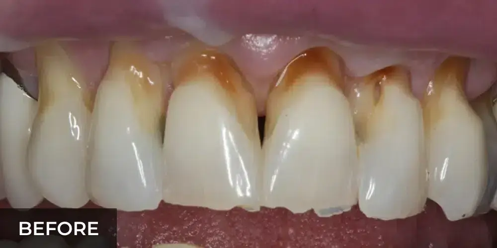 Before cosmetic smile makeover showing discolored upper front teeth with brown staining.