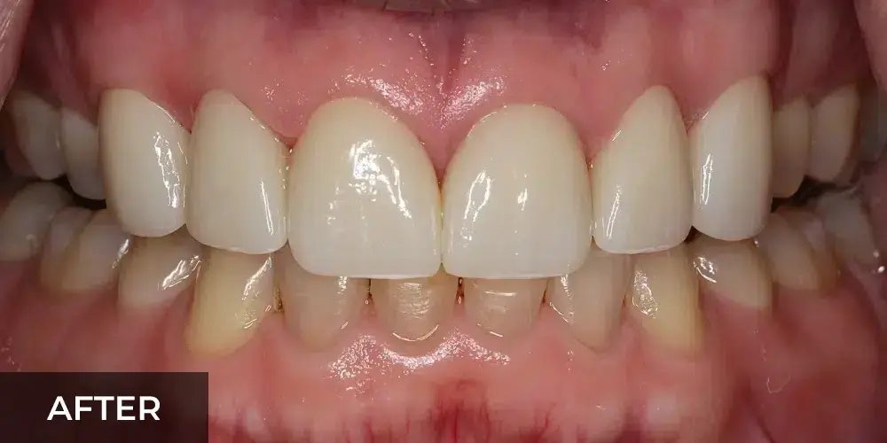 After cosmetic dental treatment showing bright white upper front teeth with improved alignment and appearance.