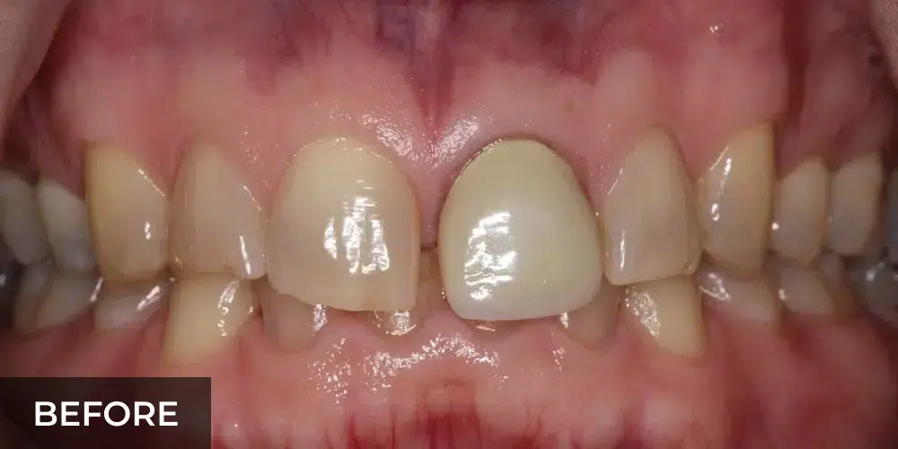 crooked teeth before