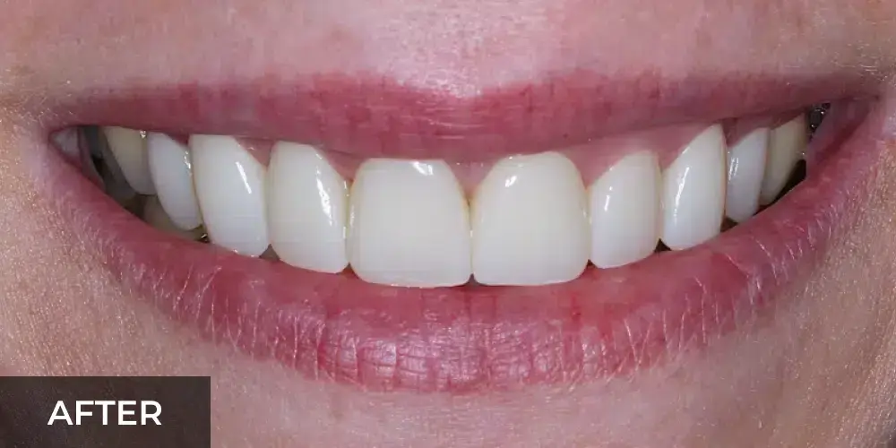After smile makeover showing bright white teeth with closed gaps in Cary, NC.