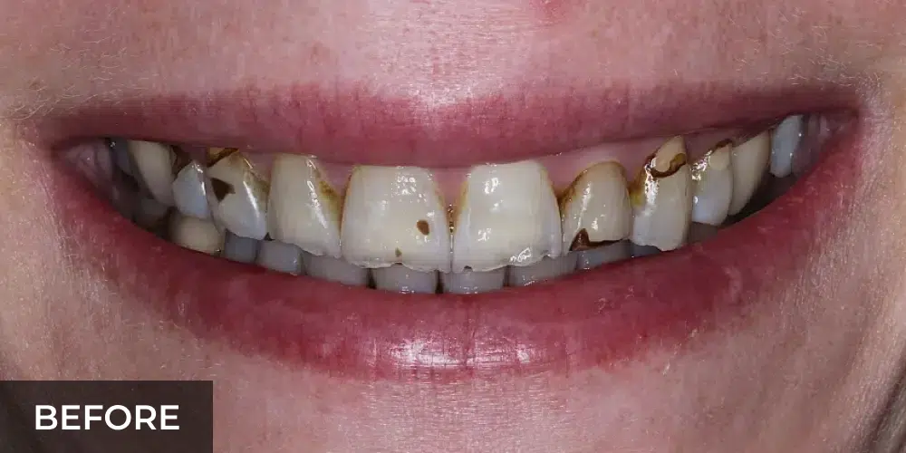 gapped front teeth before