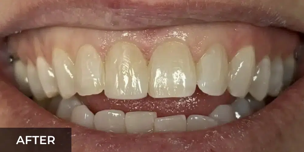 natural looking porcelain veneers after