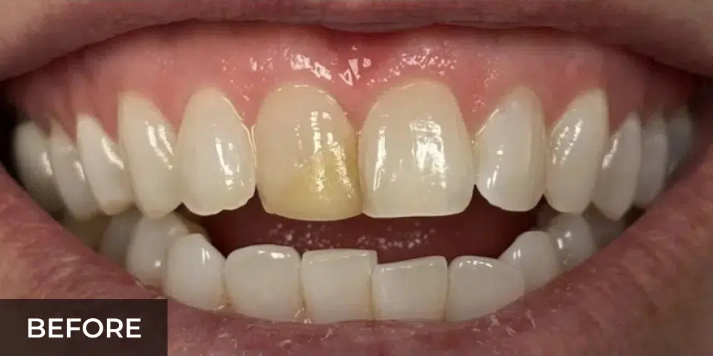 natural looking porcelain veneers before