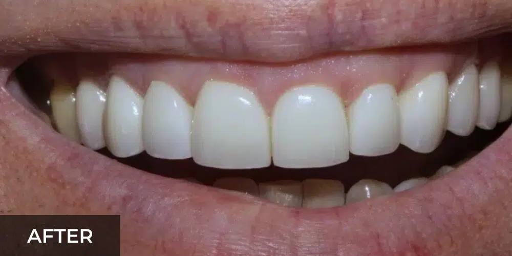 porcelain veneers after