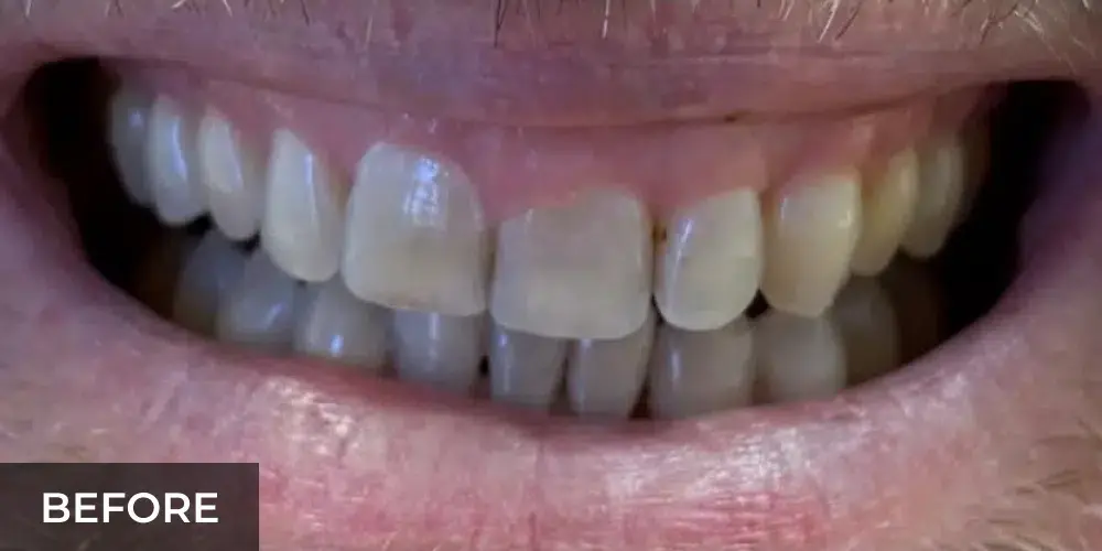 Patient smile showing discolored and uneven teeth before porcelain veneer treatment.