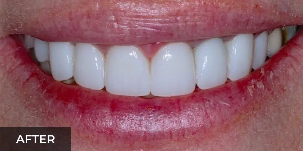 porcelain veneers smile makeover after
