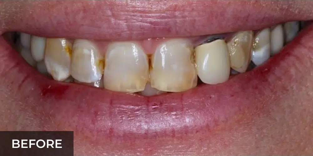porcelain veneers smile makeover before