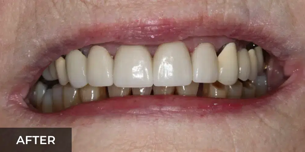 smile makeover after