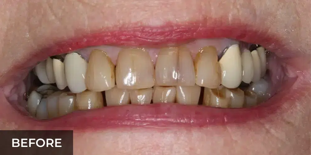 smile makeover before