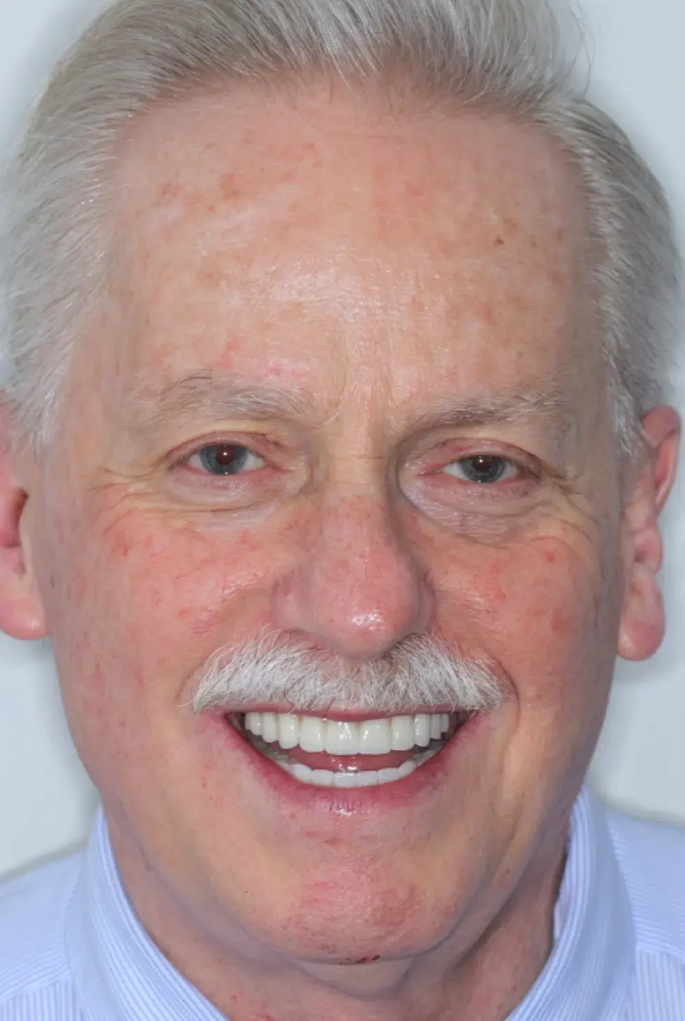 Smiling mature male patient displaying bright, healthy teeth after cosmetic dental treatment.