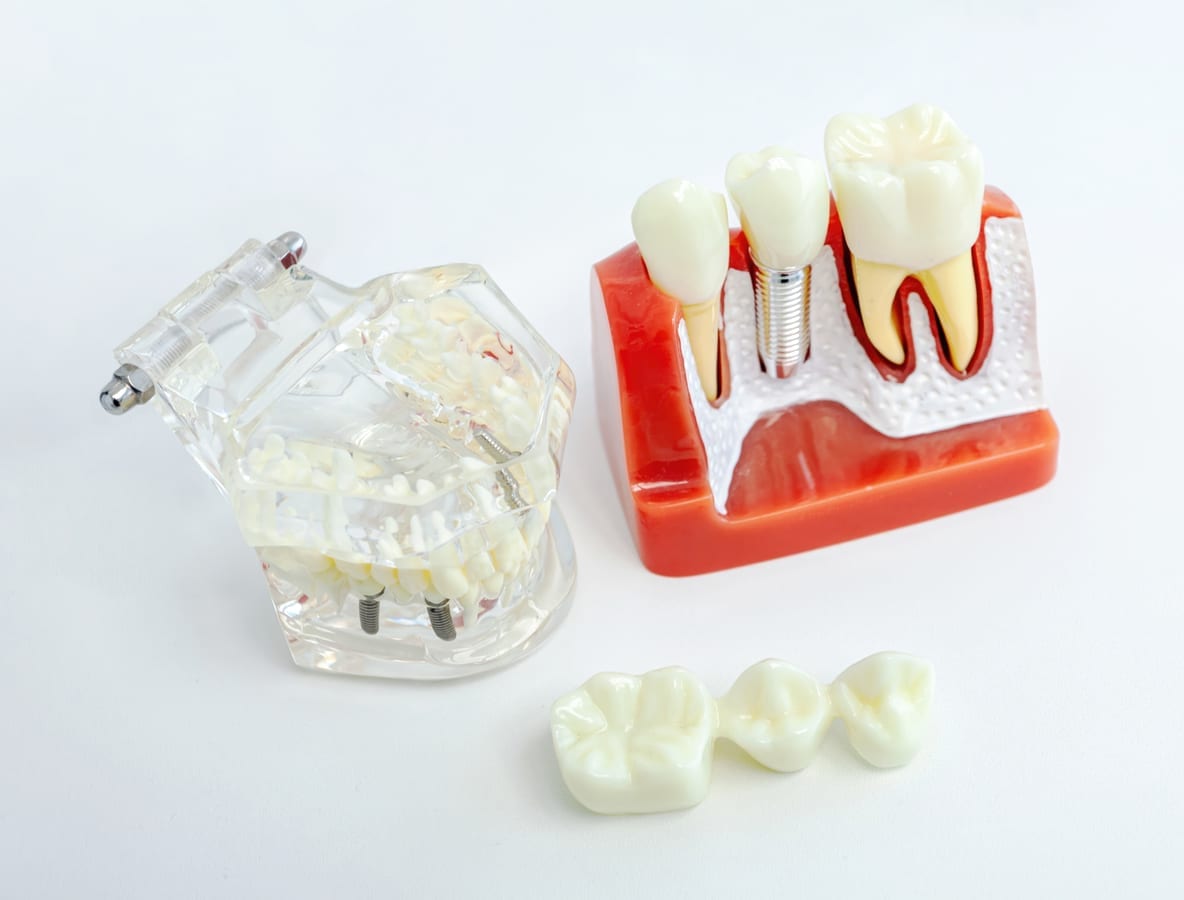 Dental Implants in Cary